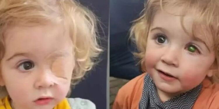 Menino de 2 anos perde a visão de um olho após ser beijado por pessoa com herpes labial